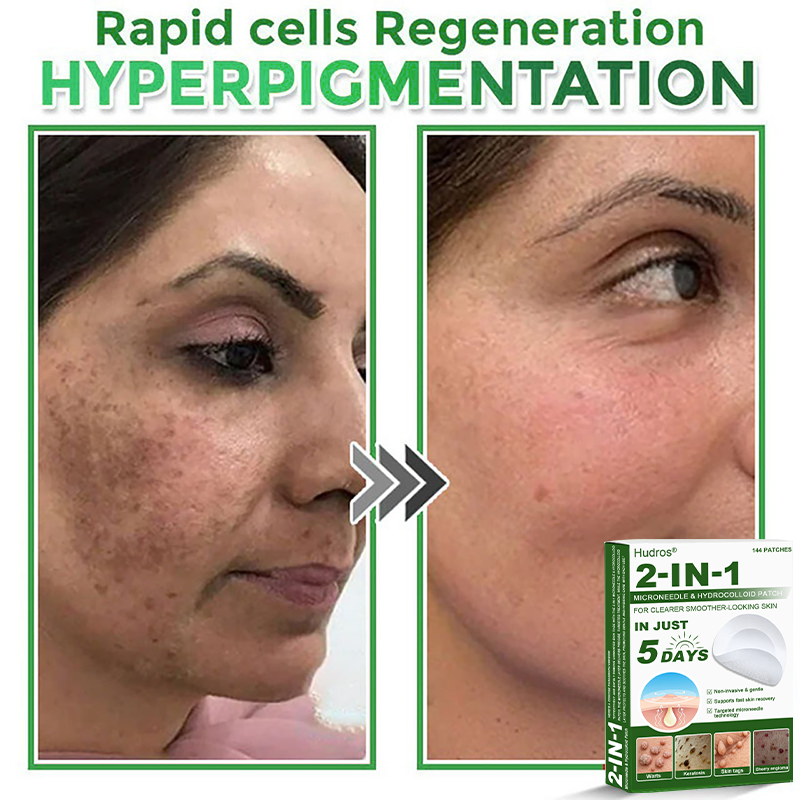 📌Hudros® 2-in-1 Microneedle & Hydrocolloid Patch | Raised Moles,Acne,  Flat Warts & Skin Tags Remover | Improves Wrinkles, Scars & Blemishes | Invisible Star Pimple Patches for Face & Body | 144 Count
