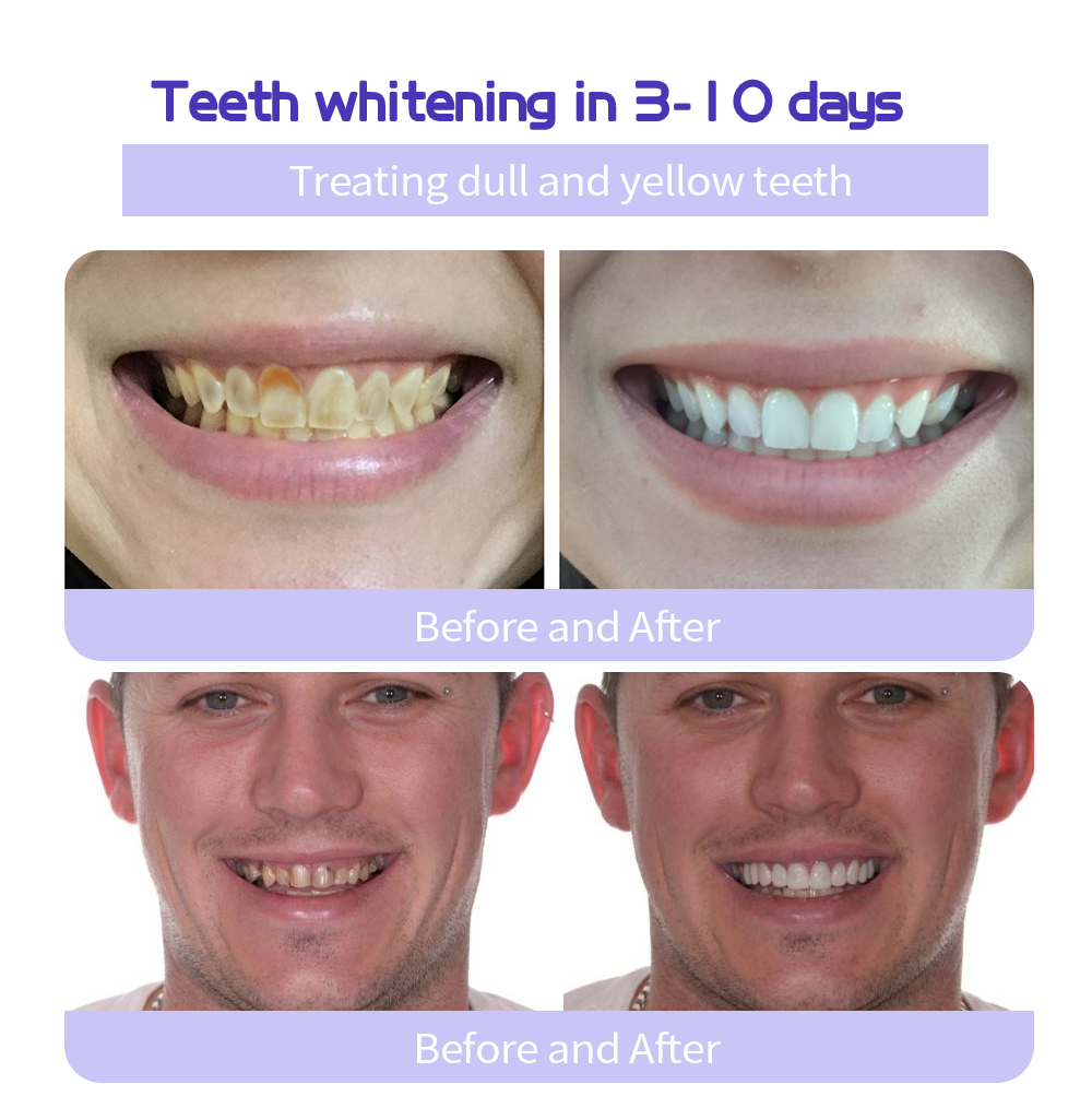 GarageLine® Teeth Restoration Mineral Powder🦷(Suitable for cavities, tooth sensitivity, gum recession, oral inflammation, periodontal problems, and various dental and oral care needs.)